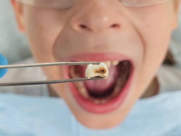 Best Emergency Dental Extractions in Hackleburg, AL
